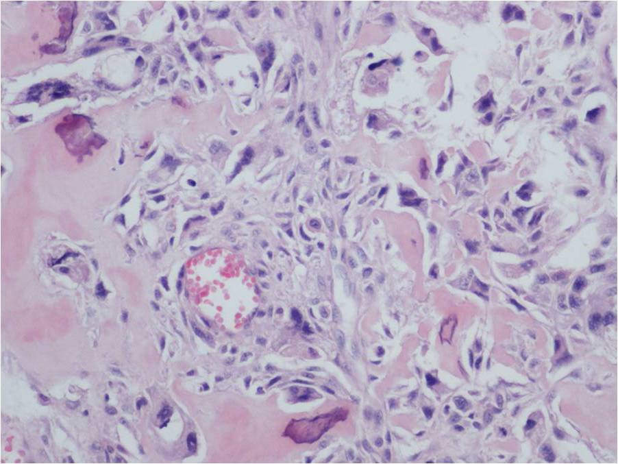 Extraskeletal Osteosarcoma Soft Tissue Osteosarcoma